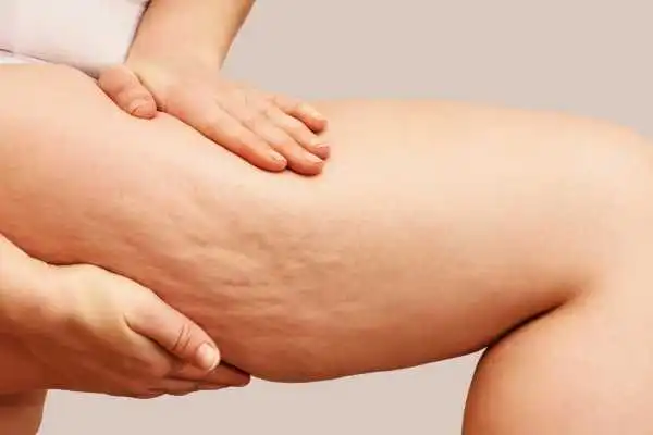 Image of woman showing leg with cellulite Falkirk