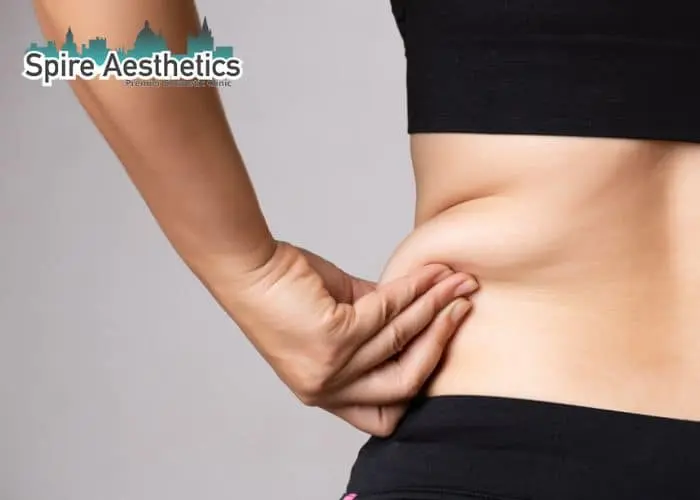 Image of woman pinching fat on their hips Falkirk. Fat Freezing treatment 