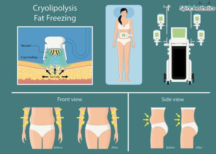 Image of diet and fat freezing combined for best results for Spire Aesthetics Falkirk