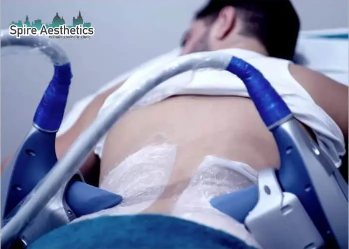 Man having fat freezing treatment done on love handles before a competitions Falkirk to create a sculpted look.