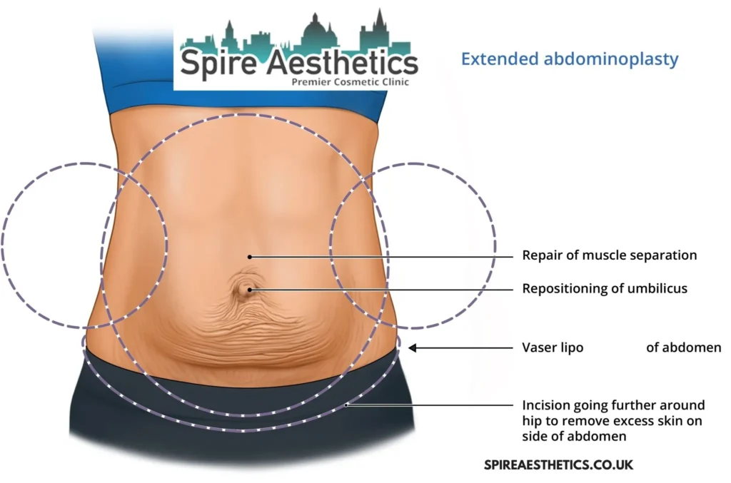 Understanding Loose Skin After Gastric Band Falkirk Surgery and HIFU Treatment