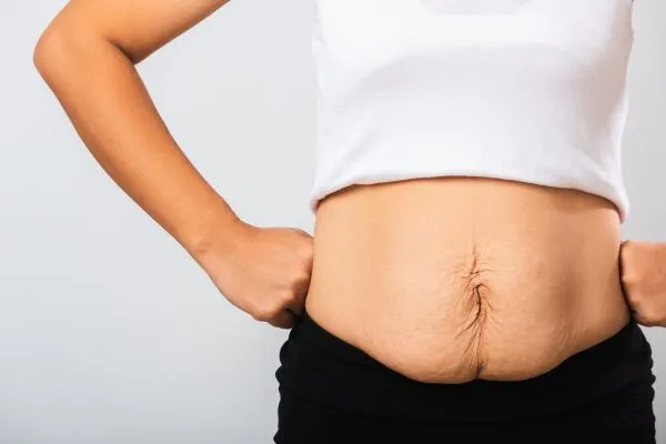 Image of a woman's stomach after weight loss with sagging skin following a gastric band Falkirk