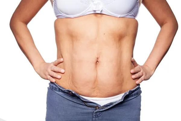 sagging skin on woman's stomach after weight loss injections Falkirk