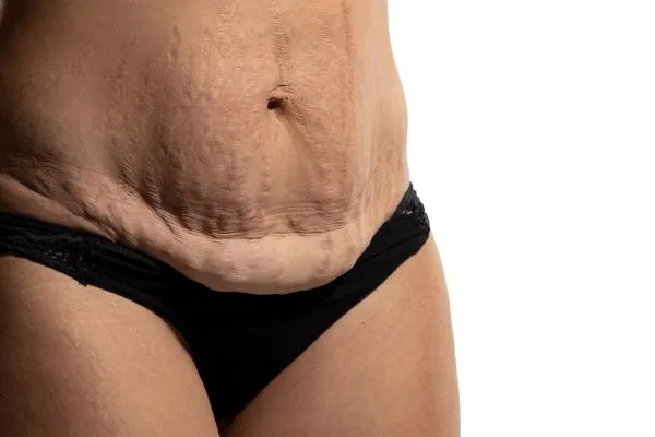 Image of womans stomach after weight loss injections Falkirk showing saggy skin