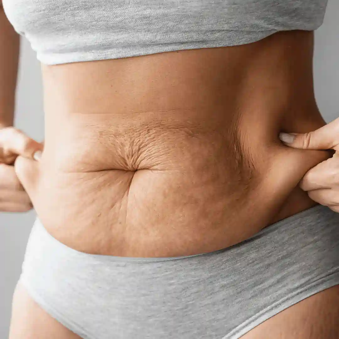 Is It Normal to Have Loose Skin After Pregnancy Falkirk?