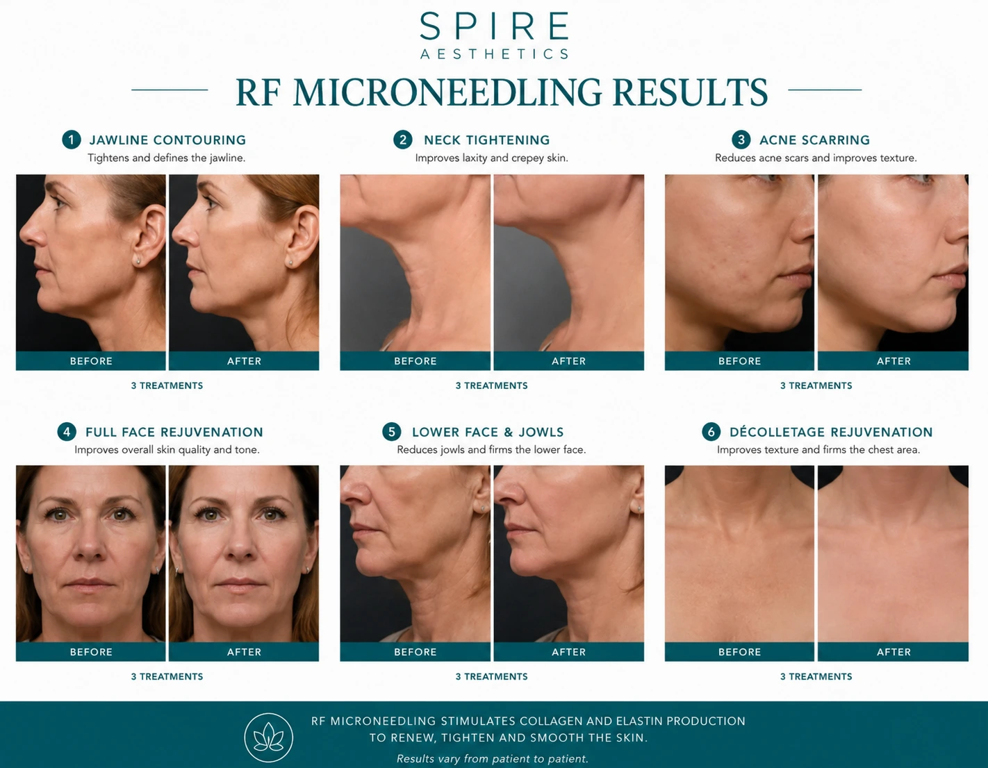 RF Microneedling Skin tightening Falkirk results