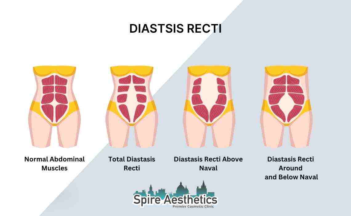Is Non-Surgical Diastasis Recti Treatment Right for You? Common Concerns Answered Falkirk